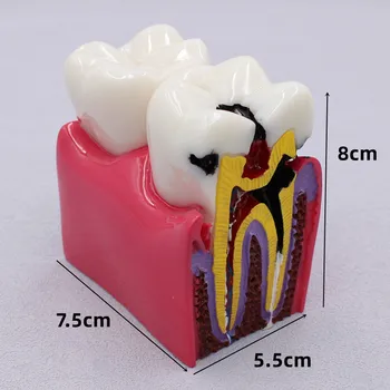 1PCS Zobozdravstveni Materiali Laboratorij Zob Model 6-Krat zobni gnilobi, ki je Comparation Študija Modeli Za Zobozdravnik Študij in Raziskovanje